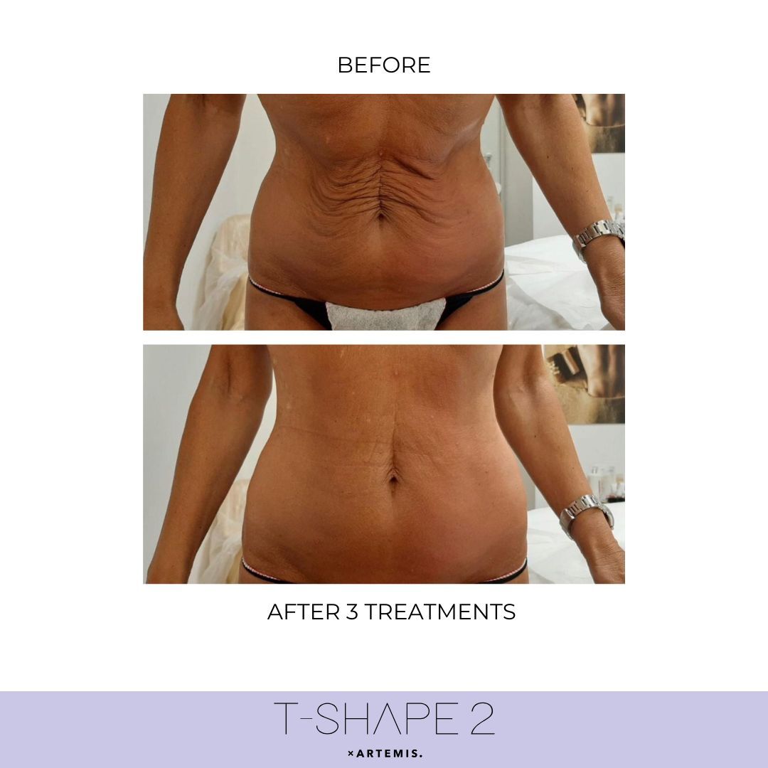 Abdomen After 3 treatments