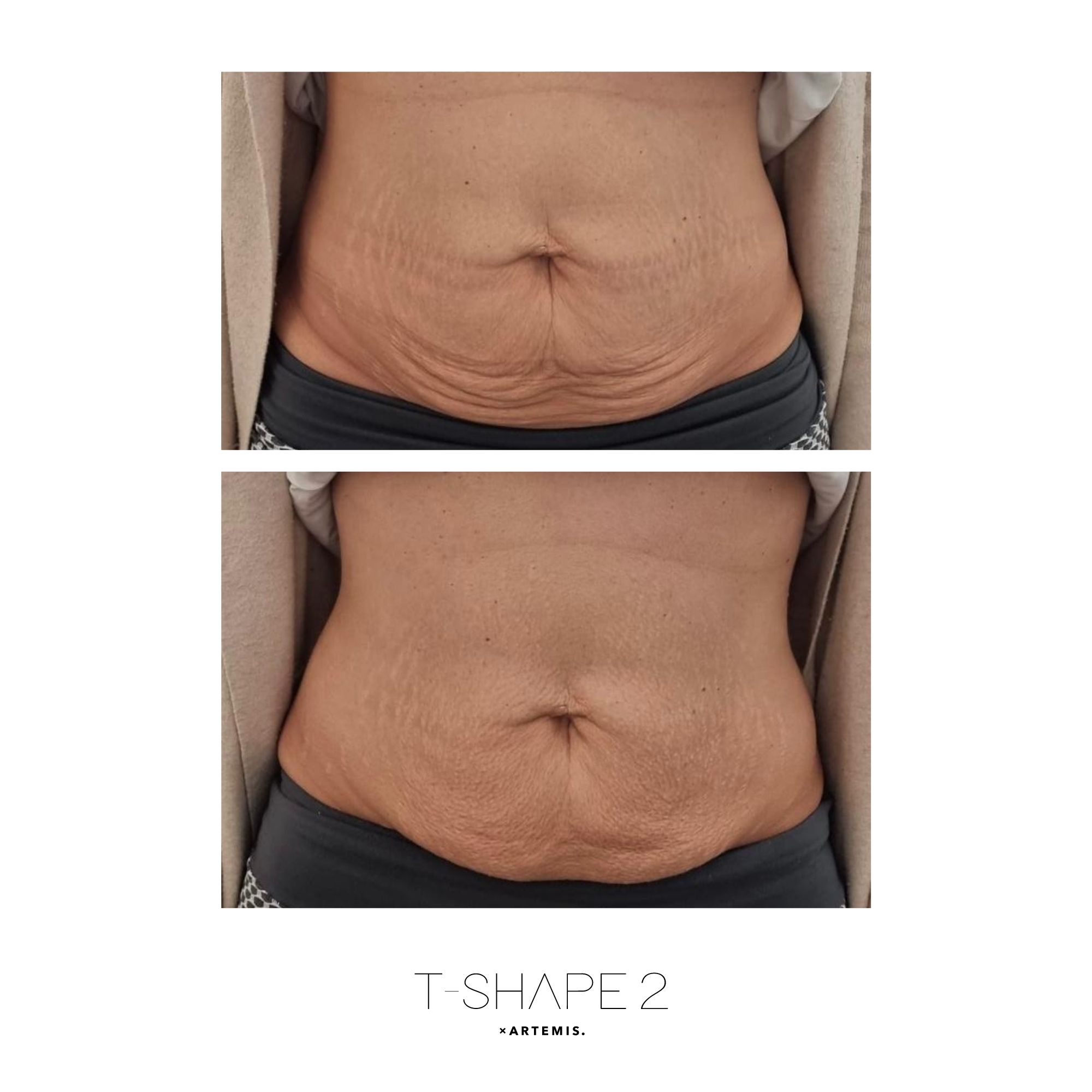 Abs After treatment series