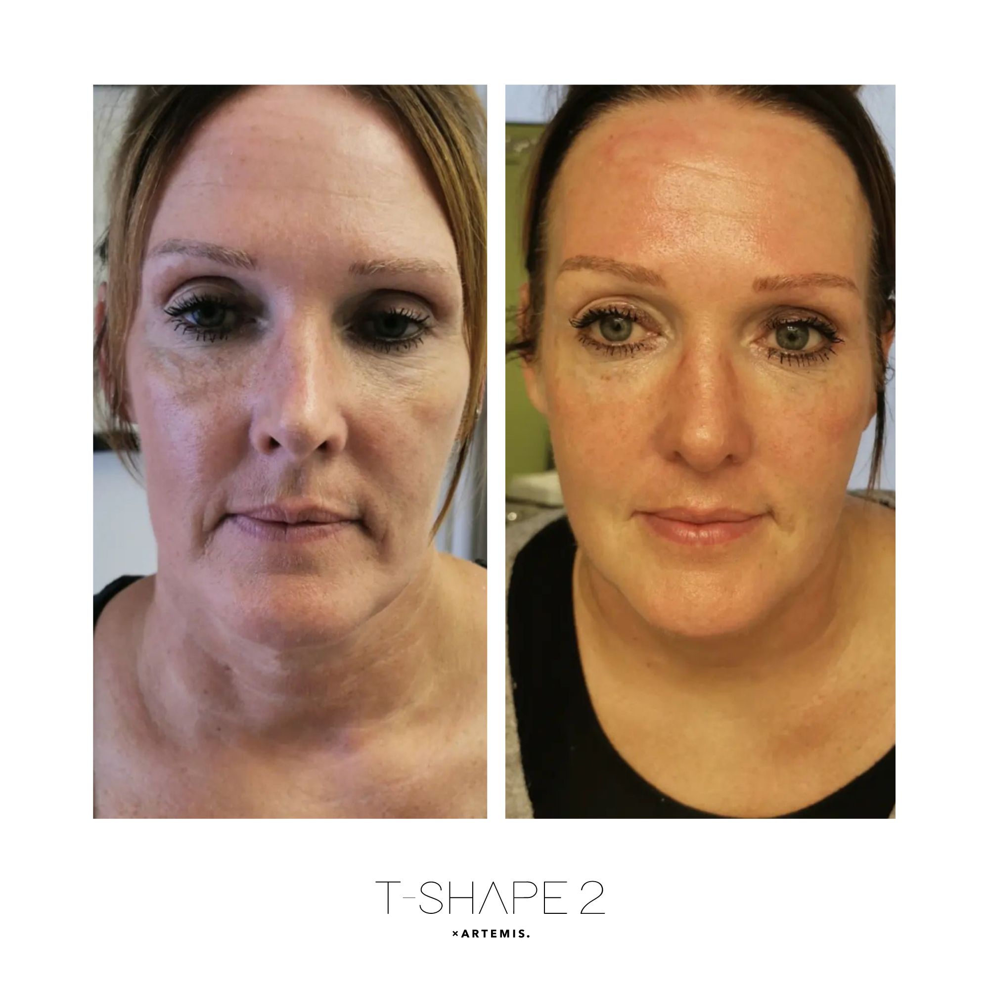 Face After 4 treatments