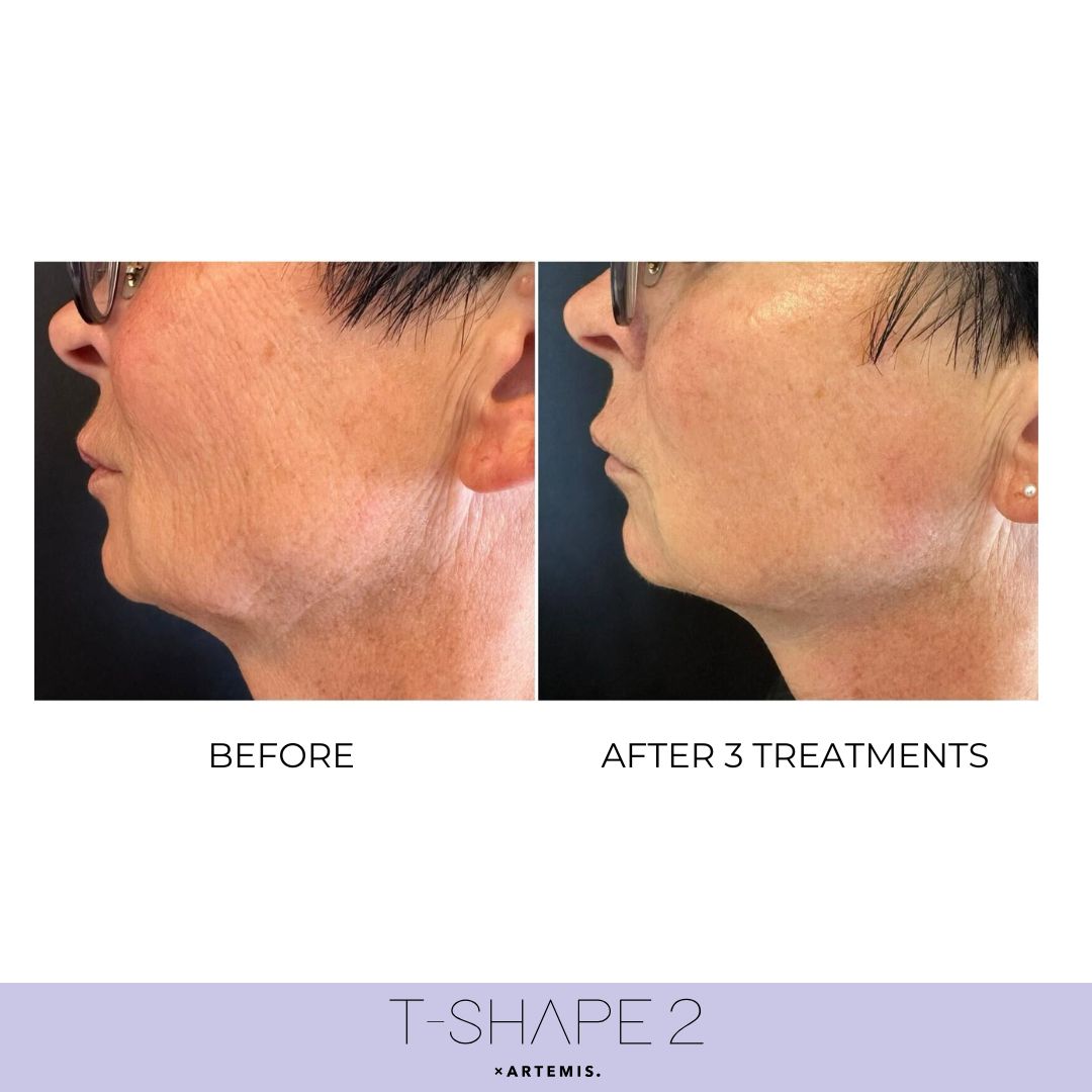 Neck After 3 treatments